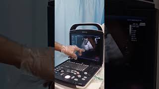 positive fast scan. ultrasound in trauma #emergencymedicine #hospital #doctor#fast #ultrasound