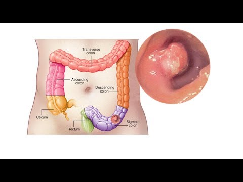 Video: Colon Tumor - Symptoms And Treatment
