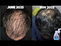 Minoxidil For Hair Growth | Side Effects Results & Tips | Minoxidil Hair regrowth result |