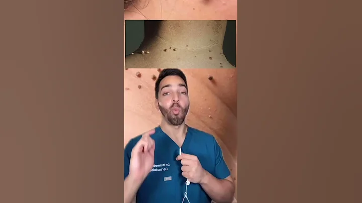 Skin Tags aka Acrochordons #shorts