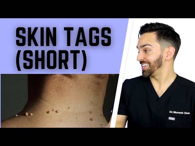 Skin Tags aka Acrochordons #shorts class=