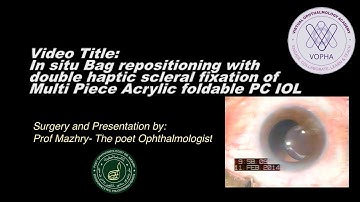In Situ IOL-Bag Complex Repositioning After PXS-Related Subluxation | VOPHA