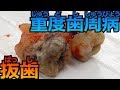 【歯科治療】重度歯周病 抜歯 Tooth extraction(重度牙周炎 拔牙)