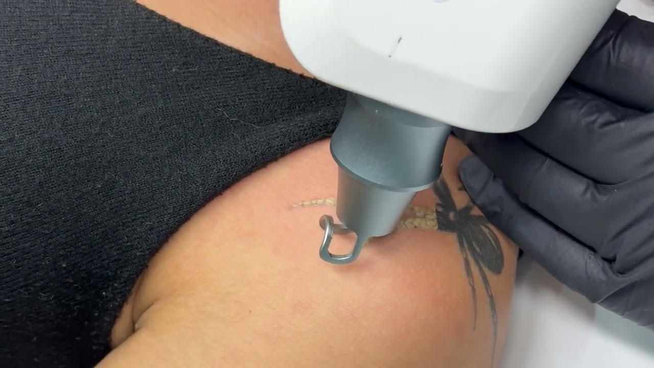 Remoção de tatuagem a laser