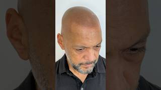 3 Session SMP Transformation – From First Hairline to Final Result