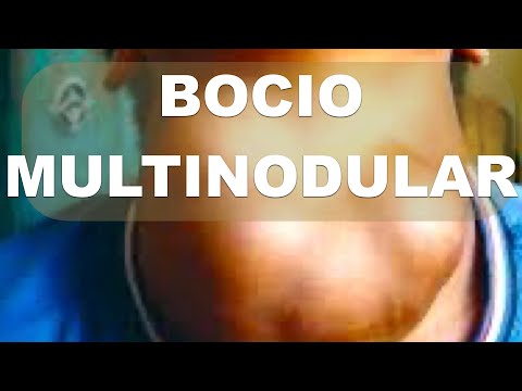 Video: ¿Los bocios multinodulares son cancerosos?