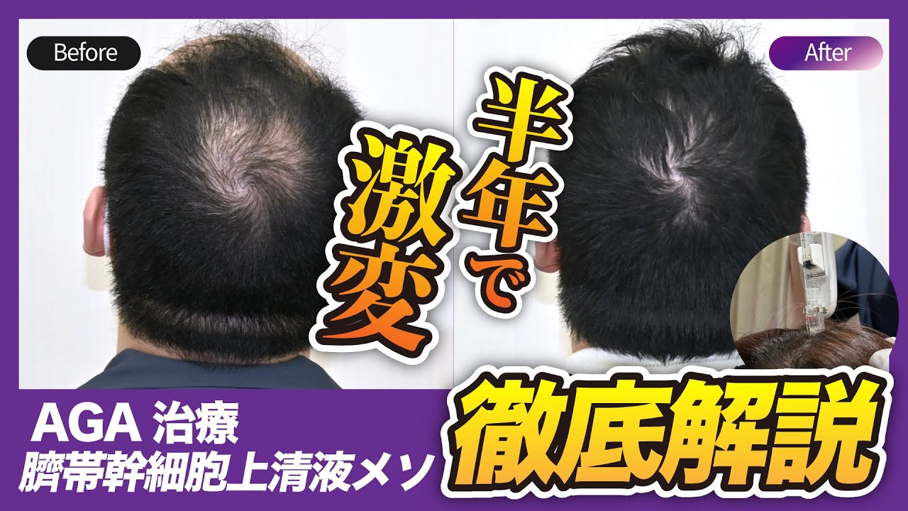 【AGA/薄毛治療】「臍帯幹細胞上清液メソ」を徹底解説！再生治療で頭頂薄毛が半年で激変！【湘南AGA仙台院 藤井医師】｜No.145