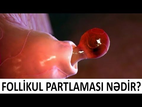 Qadınlar diqqət! Follikul nə vaxt partlayır?