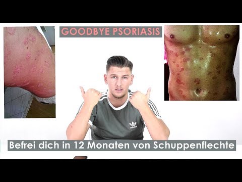 Video: Wo beginnt die Psoriasis guttata?