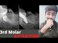 3rd molar extraction case discussion  impacted wisdom tooth  oral surgery
