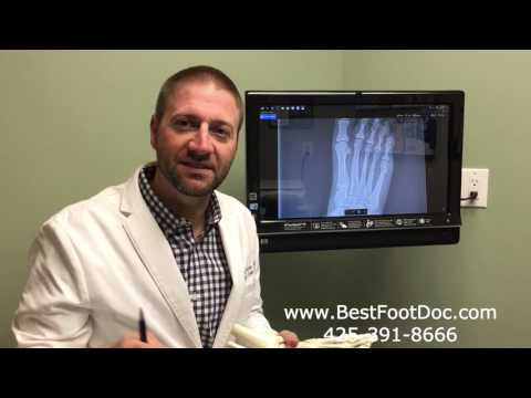 Tailor&rsquo;s Bunion -- Treatments and Information