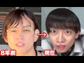 【ハゲ日記】AGA薄毛治療72ヶ月目！