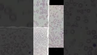 🩸 Thalassemia Patient CBC Slide 🔬 Blood Film Review #thalassemia #cbc #hematology #shorts