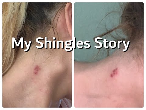 Video: Shingles Recurrence: Yang Harus Anda Ketahui