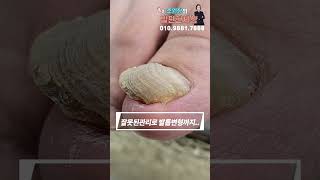 전~~혀 관리를 안한 내성발톱 #shorts #내성발톱 #무좀발톱 #무좀관리 #ingrown #toenails