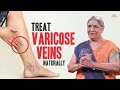 Natural Cure for Varicose Veins | Home Remedies to Treat Varicose Veins | Dr. Hansaji Yogendra