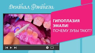 🤔  Гипоплазия эмали! Почему зубы тают?