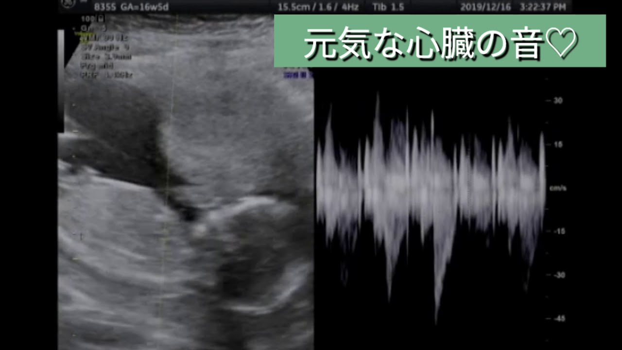 16週5日目 エコー動画 性別が分かるまでの道のり ようこそ母ちゃんのお腹へ Youtube