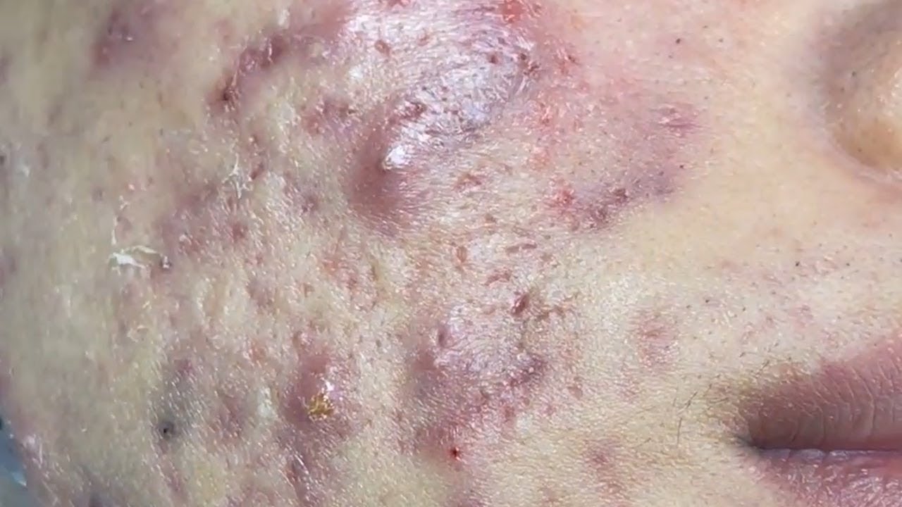 Blackheads & Milia, Big Cystic Acne Blackheads Extraction Whiteheads
