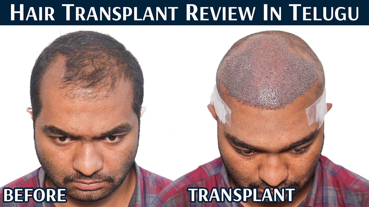 Hair Transplant in Bhopal  Best Clinic For Hair Transplant
