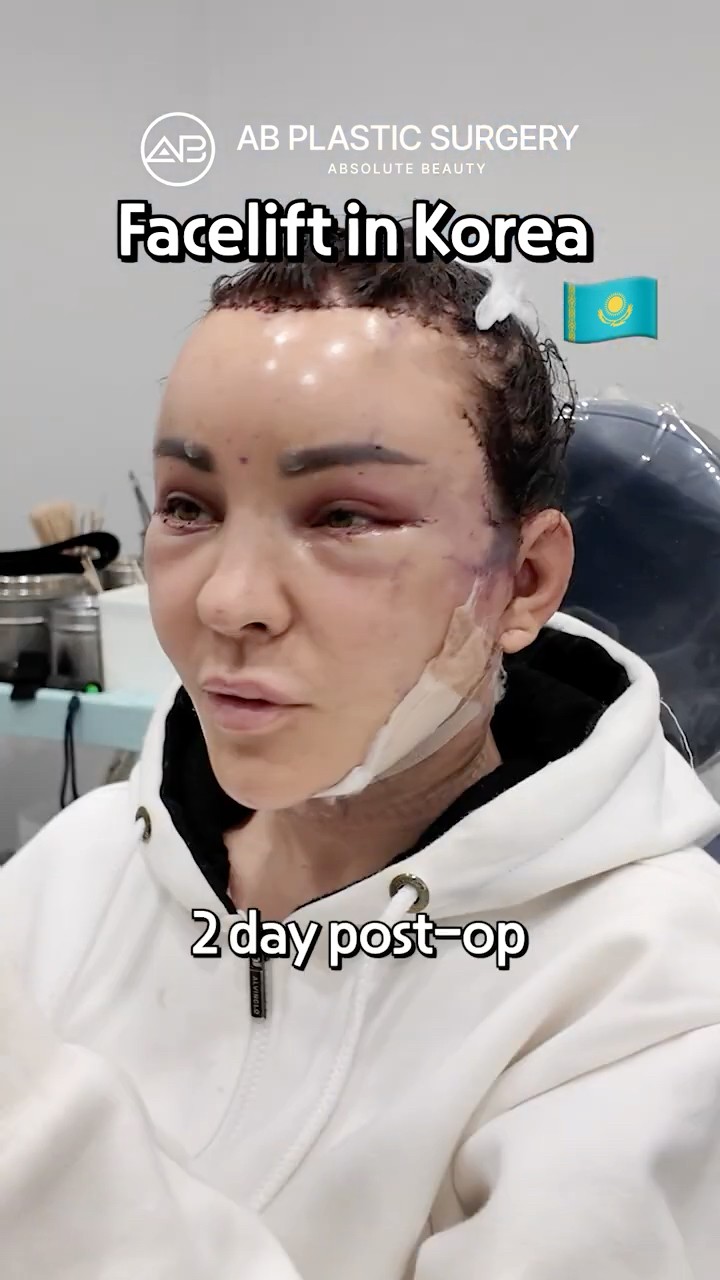 I Finally Got a Facelift in Korea… Here’s What Happened #shorts