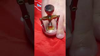 Toe Nail Fixer| Ingrown Toenail Cleaning & Care #ToenailFix #NailCare #FootCare #PedicureClean