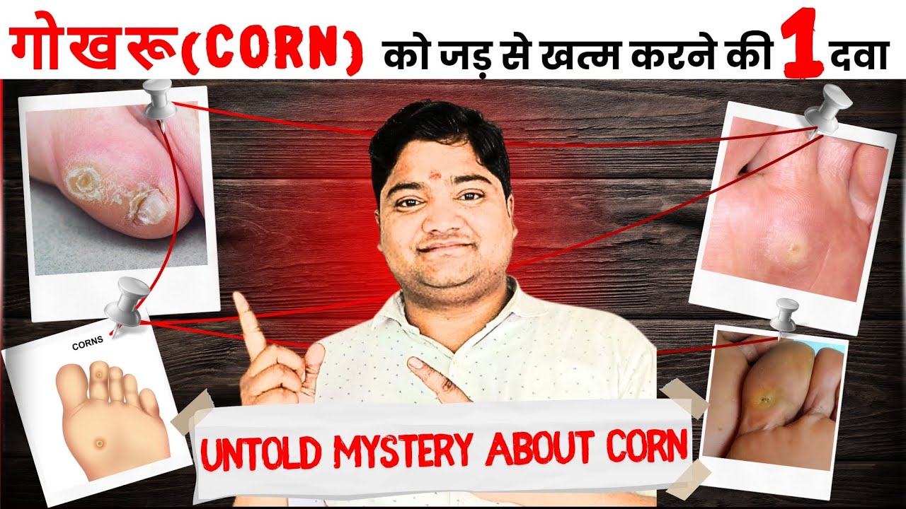 Corn on foot | How to get rid of corn on foot | corn removal - YouTube