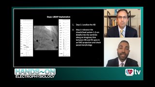Celebrity Hands-On Electrophysiology: Left Bundle Branch Pacing Profile