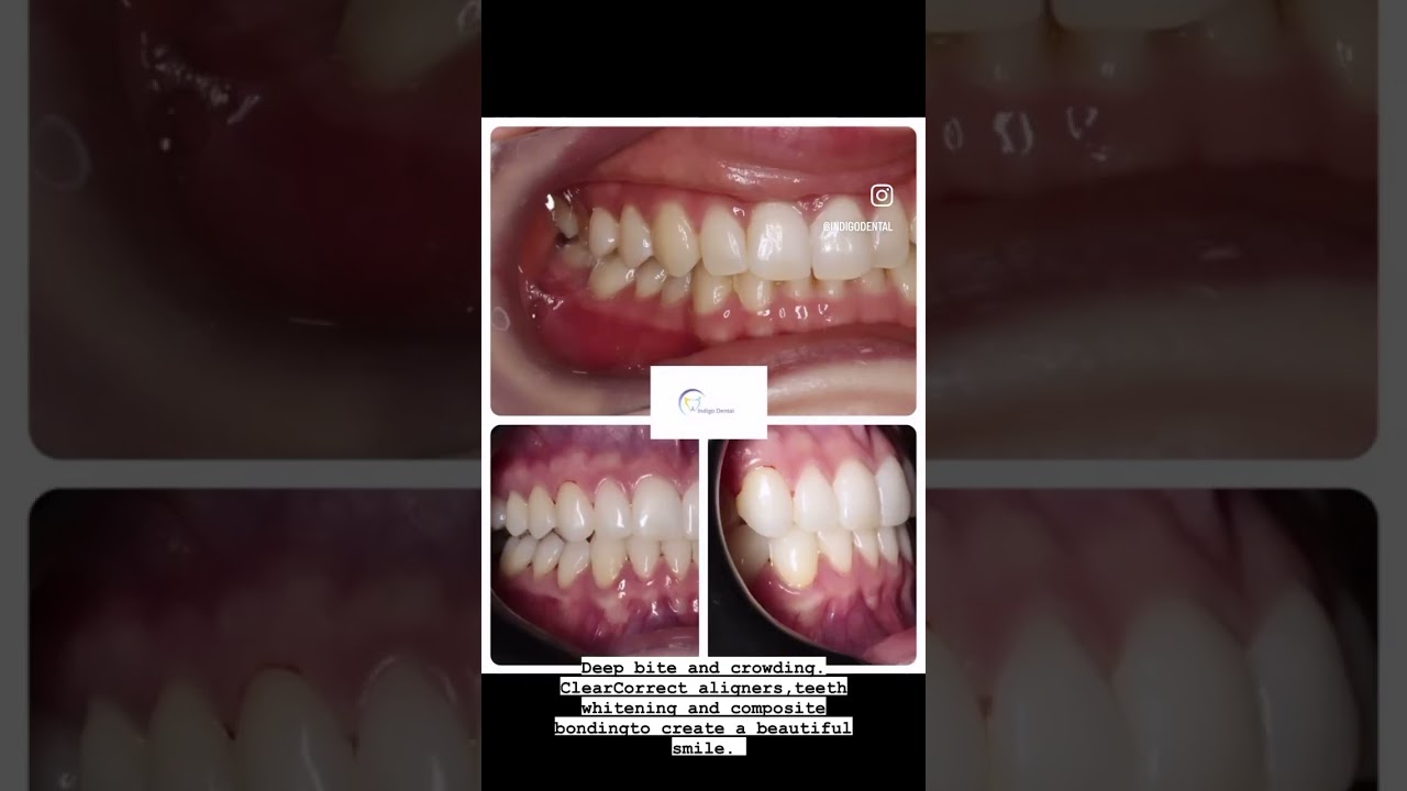 ClearCorrect aligners and teeth whitening. 