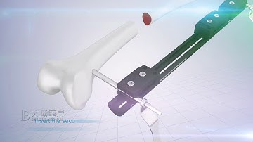 Double Medical OF Limb Reconstruction System