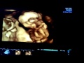 Twin 15 Weeks Gender Ultrasound 4D 3D توأم غير متماثل الأسبوع ال15 اشعة سونار تحديد الجنس 