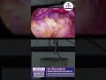 Why blocked tubes prevent pregnancy #InfertilityTreatment #Laparoscopy