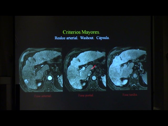 Hepatocarcinoma revisión actualizada del lirads.  Diego Haberman