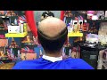 تركيب شعر طبيعي 100 مع المتخصص العالمي ابراهيم رزق