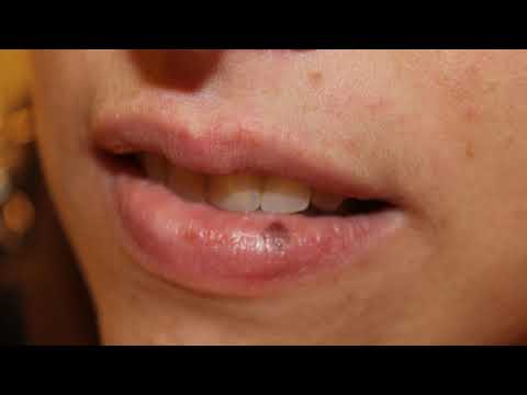 macula melanotica Mcula Melantica: O que voc precisa saber? Oral Melanotic Macule: Symptoms and