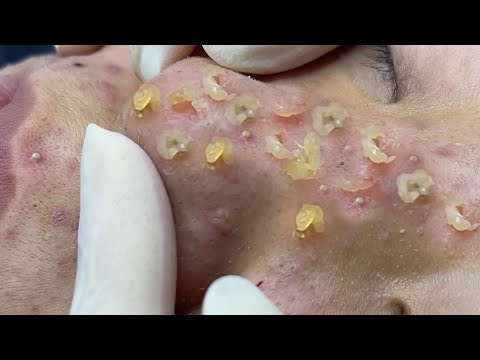 [NOSE] Relaxing with Sac Dep, WIN Spa, Loan Nguyen Official, Snake Tahunet Remove Blackhead