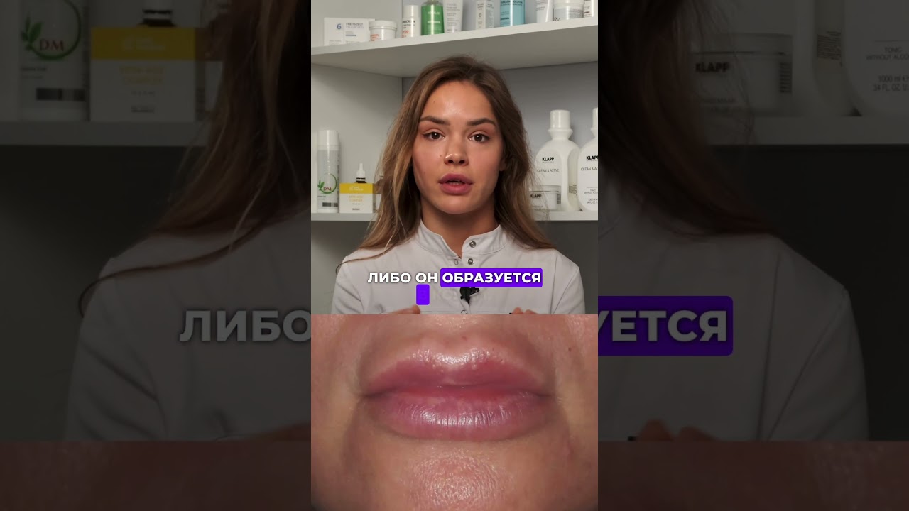 Что такое миграция филлера при увеличении губ #косметология #врачкосметолог #увеличениегуб