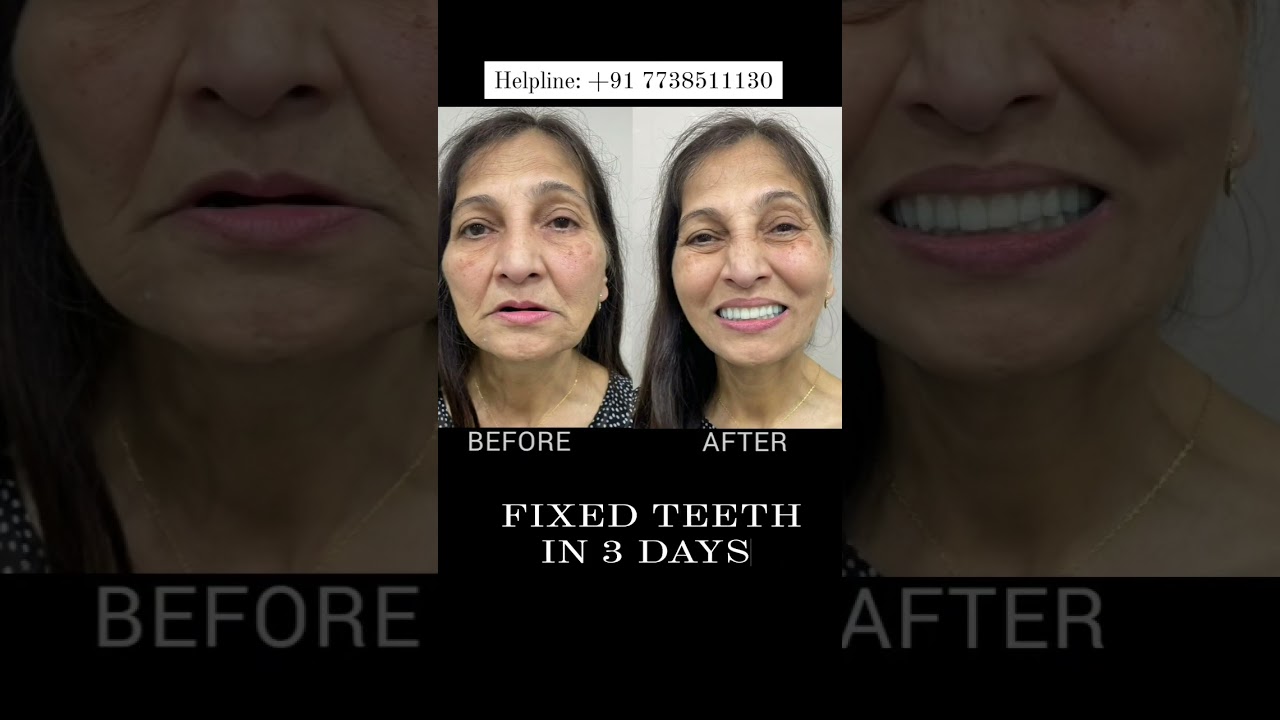 Fixed Teeth In 3 Days 