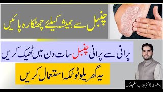 सोरायसिस दोबारा नहीं होगा | Psoriasis Cure،چنبل کا آسان گھریلو علاج