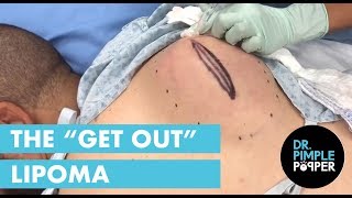 The GET OUT Lipoma