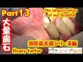 上尾 歯医者 歯周病 当院最大級の大量歯石取り(歯石除去)シリーズ 30代男性 パート13,Mass tartar,टैटार, 韃靼,หินปูน,Heavy tartar,ขูดหินปูน