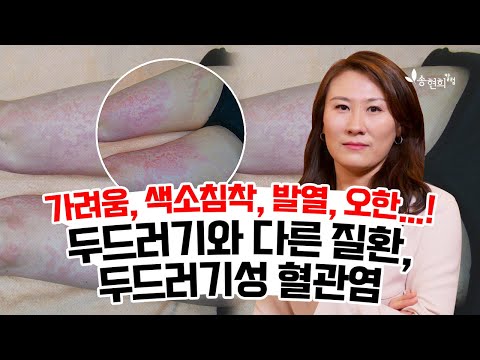 두드러기같은데 항히스타민제가 소용 없어요 두드러기성 혈관염 