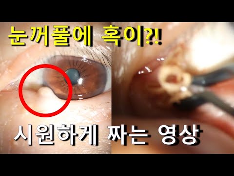 눈꺼풀에 혹이 났다?! 눈꺼풀 피지 짜기.