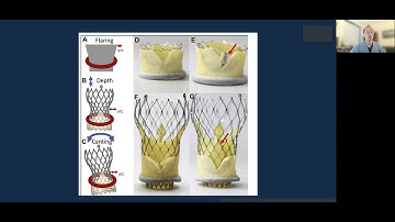 2022 TATCS: Lifetime Management of AV Disease