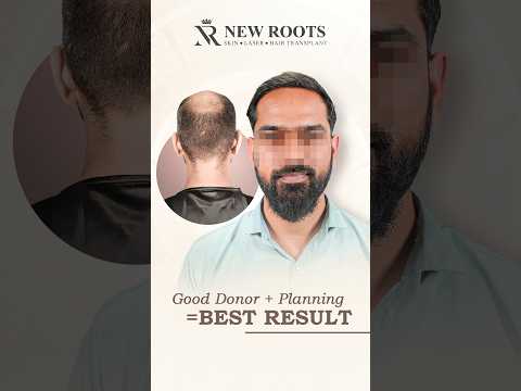 Hair Transplant in Pune | Grade 6 Baldness | Before and After Results | Best Cost #shorts