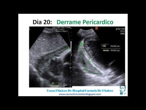 Vídeo: Acurácia Diagnóstica Da PCR Quantitativa (Xpert MTB / RIF) Para Pericardite Tuberculosa Em Comparação Com Adenosina Desaminase E Interferon-γ Não Estimulado Em Ambiente De Alta Car