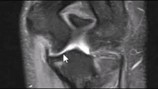 UCL tear involving the posterior band