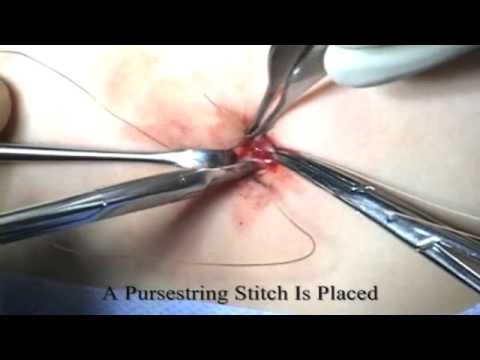 todd ponsky single incision gastrostomy tube in a child t tube placement