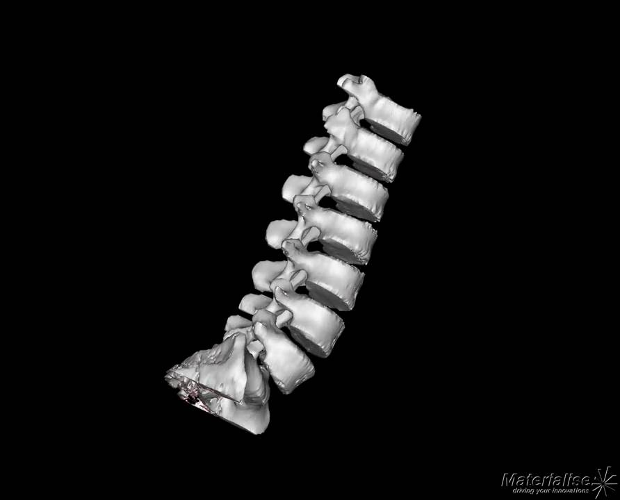 Spine - Lumbar - 3D medical model - Spondylosis - 269788-01 - YouTube