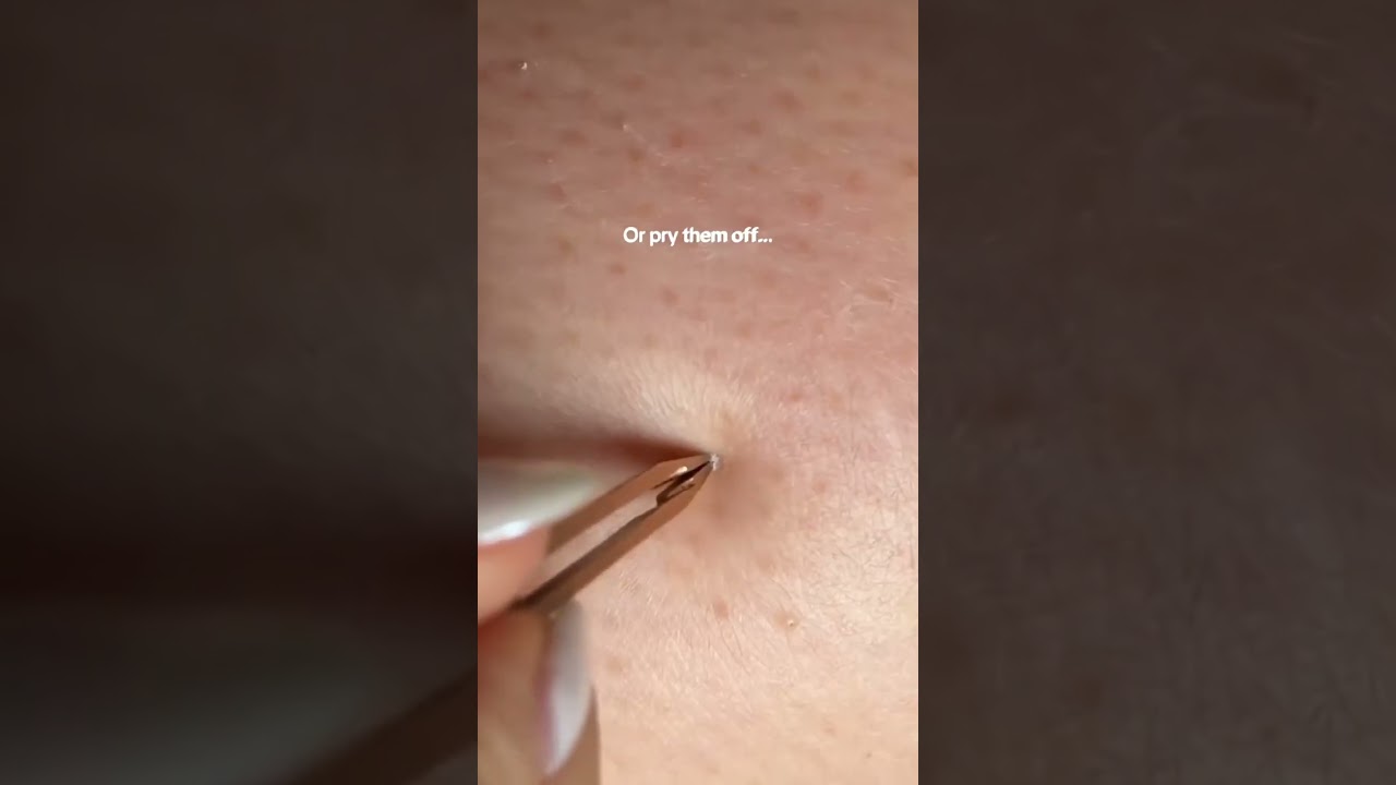 Stop bullying people for their skin 😪